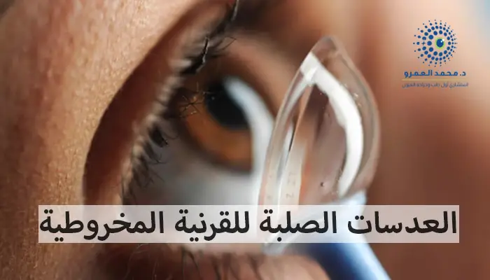 العدسات الصلبة للقرنية المخروطية