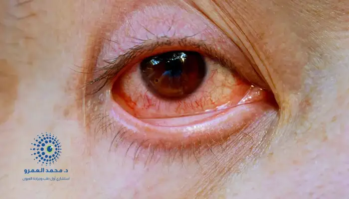 احمرار العين عند كبار السن