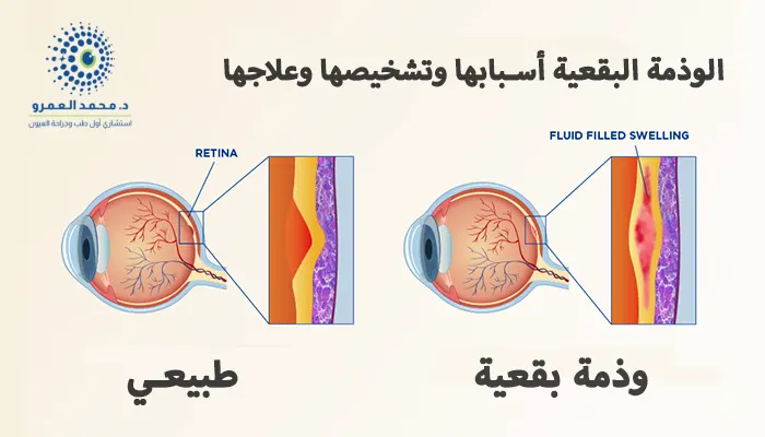 الوذمة البقعية أسبابها وتشخيصها وعلاجها