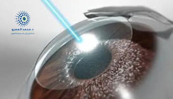 أحدث تقنيات الليزك لتحسين الرؤية الليلية