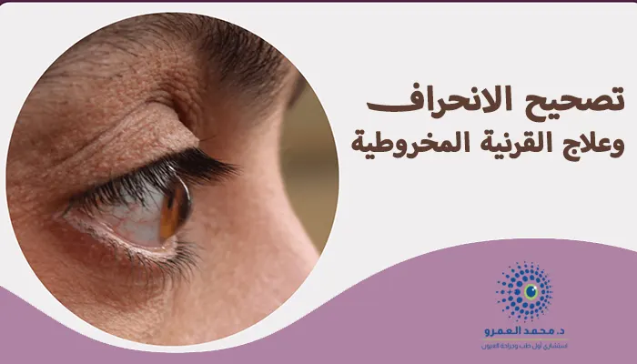 تصحيح الانحراف وعلاج القرنية المخروطية