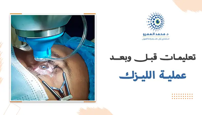 تعليمات قبل وبعد عملية الليزك