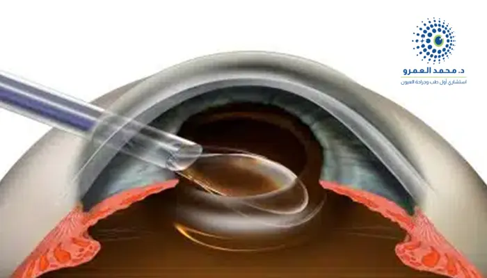 زرع العدسات في عملية الماء الأبيض