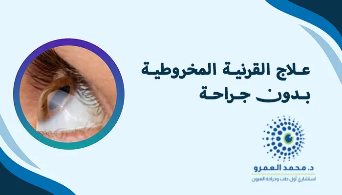 علاج القرنية المخروطية بدون جراحة