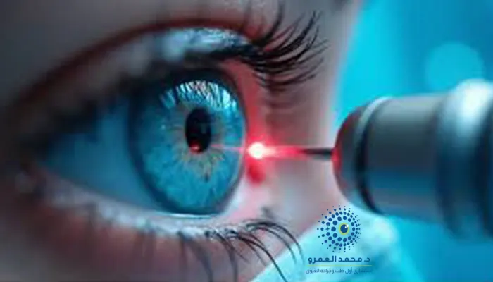 نتائج عملية تصحيح النظر بالليزر