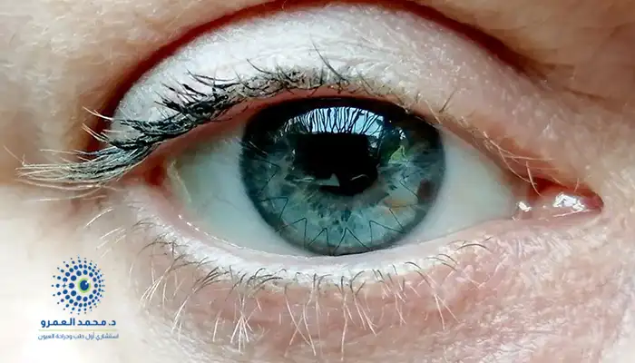 تجربتي مع زراعة القرنية في الرياض