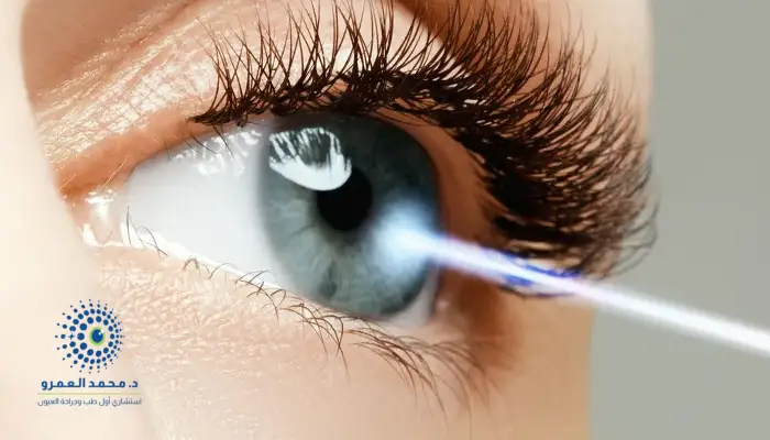 شروط إجراء عملية الليزك