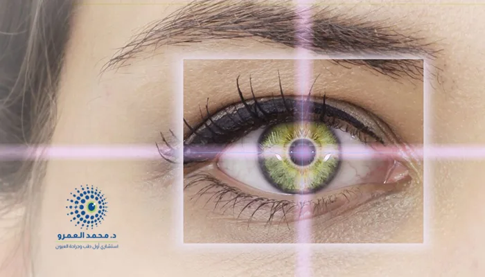 متى تلتئم العين بعد عملية تصحيح النظر؟