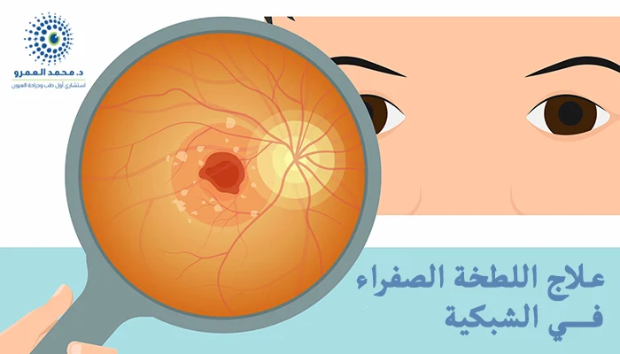 علاج اللطخة الصفراء في الشبكية