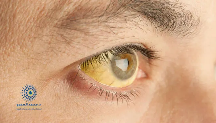 متى يكون اصفرار العين طبيعي؟