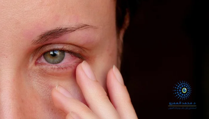 هل التهاب العيد معدي؟ وكيف ينتقل من شخص لآخر؟